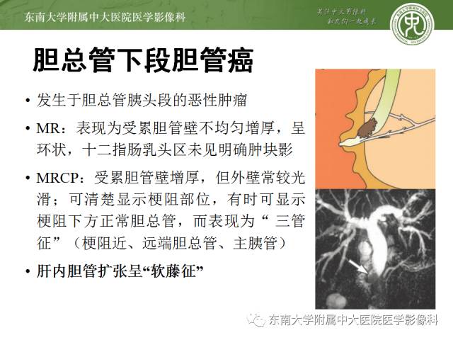 【病例】十二指肠乳头腺癌1例CT影像表现