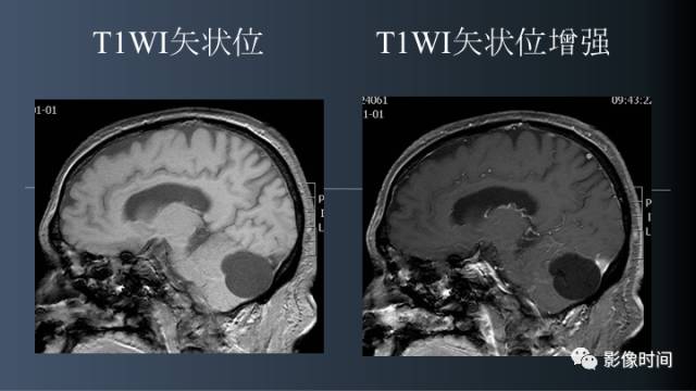 【病例】后颅窝囊性占位：脑内？脑外？——囊性脑膜瘤1例MR
