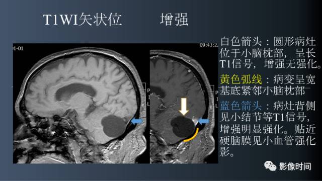 【病例】后颅窝囊性占位：脑内？脑外？——囊性脑膜瘤1例MR
