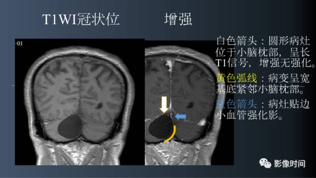 【病例】后颅窝囊性占位：脑内？脑外？——囊性脑膜瘤1例MR