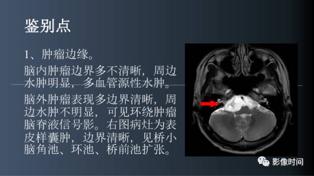 【病例】后颅窝囊性占位：脑内？脑外？——囊性脑膜瘤1例MR