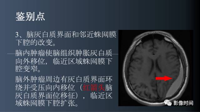 【病例】后颅窝囊性占位：脑内？脑外？——囊性脑膜瘤1例MR