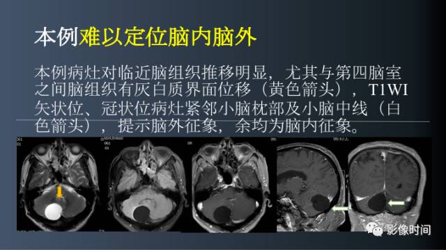【病例】后颅窝囊性占位：脑内？脑外？——囊性脑膜瘤1例MR
