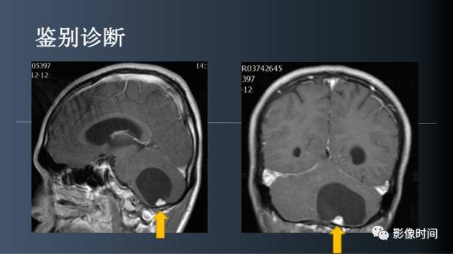 【病例】后颅窝囊性占位：脑内？脑外？——囊性脑膜瘤1例MR