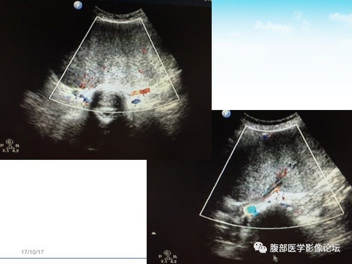 【病例】小肠系膜侵袭性纤维瘤病1例CT影像表现