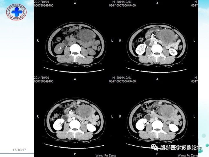 【病例】小肠系膜侵袭性纤维瘤病1例CT影像表现