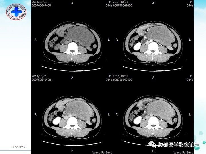 【病例】小肠系膜侵袭性纤维瘤病1例CT影像表现