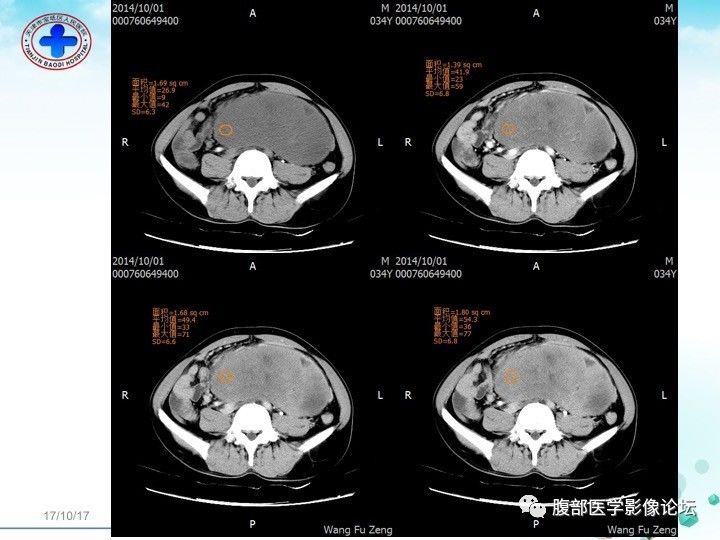 【病例】小肠系膜侵袭性纤维瘤病1例CT影像表现