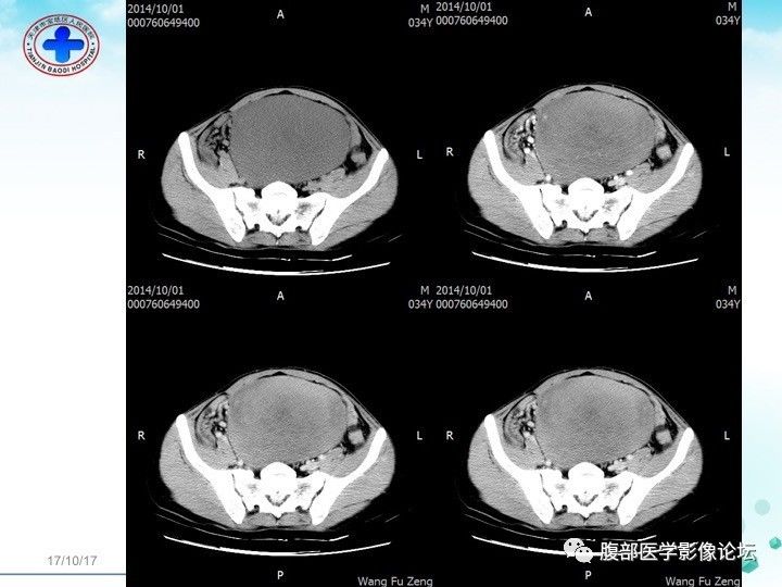 【病例】小肠系膜侵袭性纤维瘤病1例CT影像表现