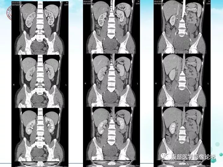 【病例】小肠系膜侵袭性纤维瘤病1例CT影像表现