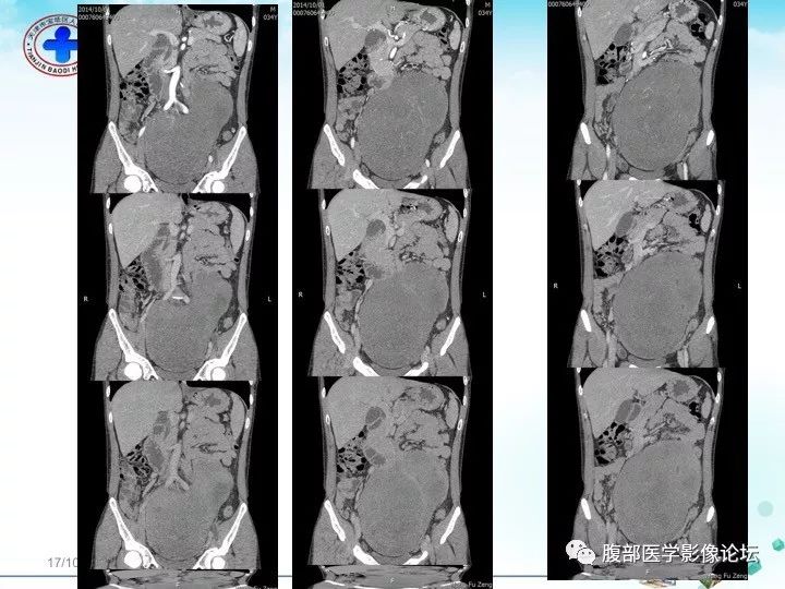 【病例】小肠系膜侵袭性纤维瘤病1例CT影像表现