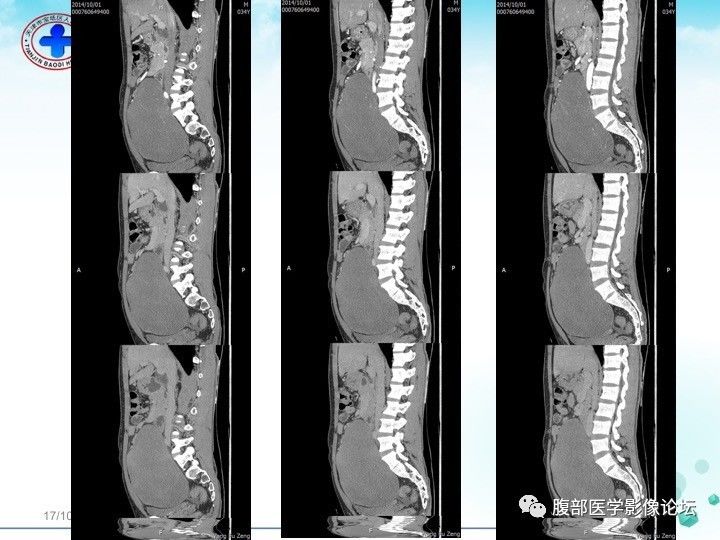 【病例】小肠系膜侵袭性纤维瘤病1例CT影像表现