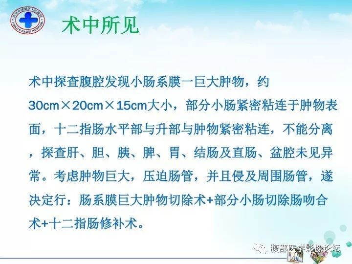 【病例】小肠系膜侵袭性纤维瘤病1例CT影像表现