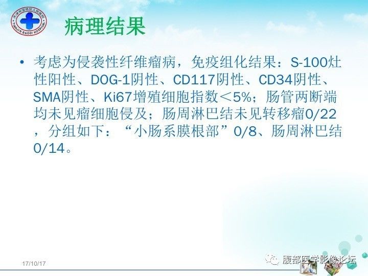 【病例】小肠系膜侵袭性纤维瘤病1例CT影像表现