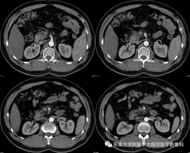 【病例】自发性孤立性肠系膜上动脉夹层1例CT
