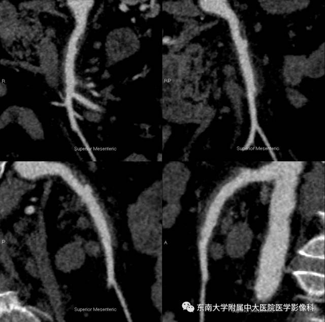 【病例】自发性孤立性肠系膜上动脉夹层1例CT