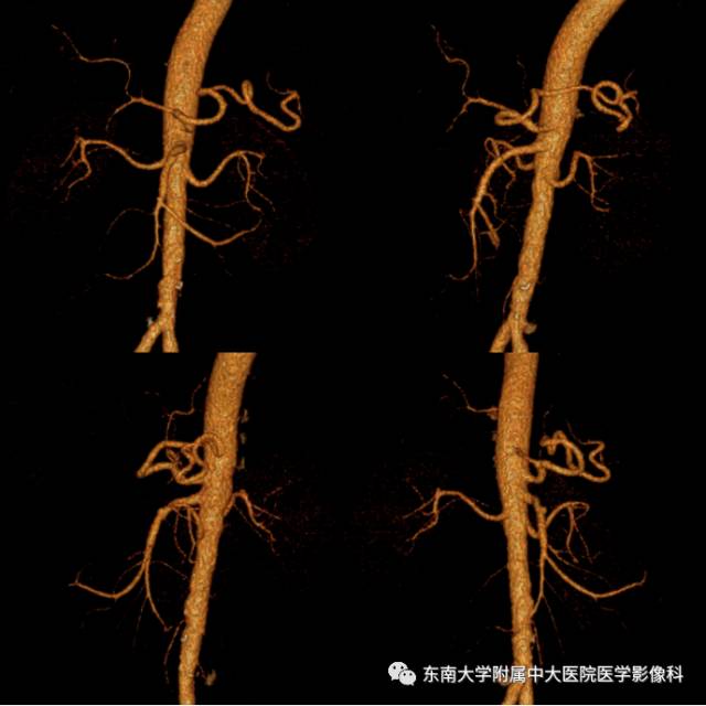 【病例】自发性孤立性肠系膜上动脉夹层1例CT