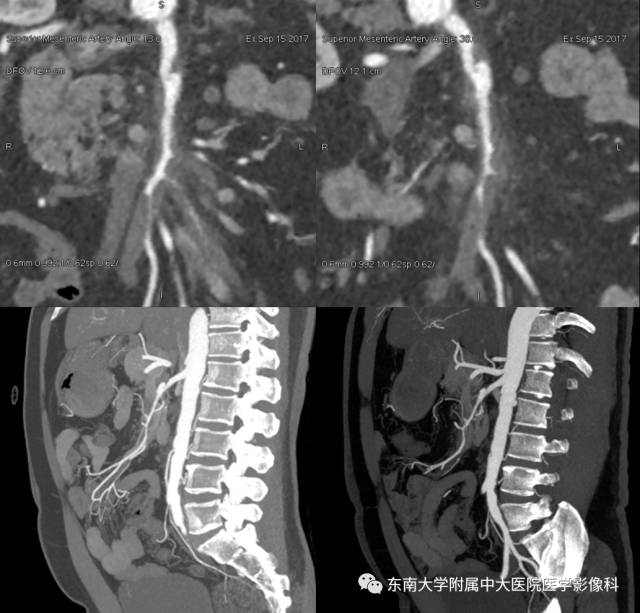 【病例】自发性孤立性肠系膜上动脉夹层1例CT