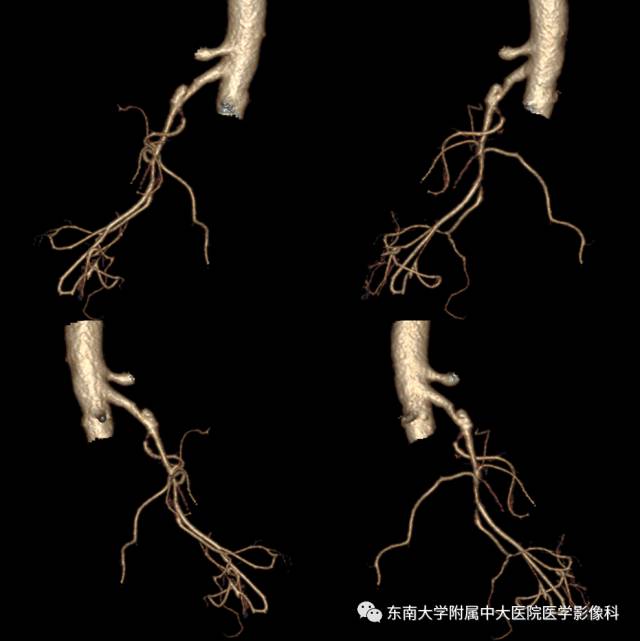 【病例】自发性孤立性肠系膜上动脉夹层1例CT
