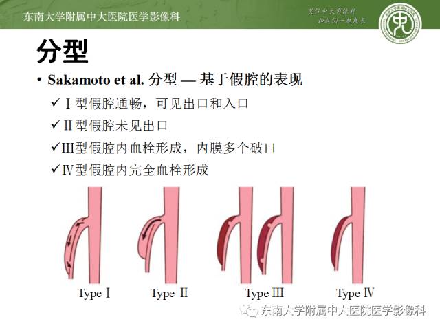 【病例】自发性孤立性肠系膜上动脉夹层1例CT