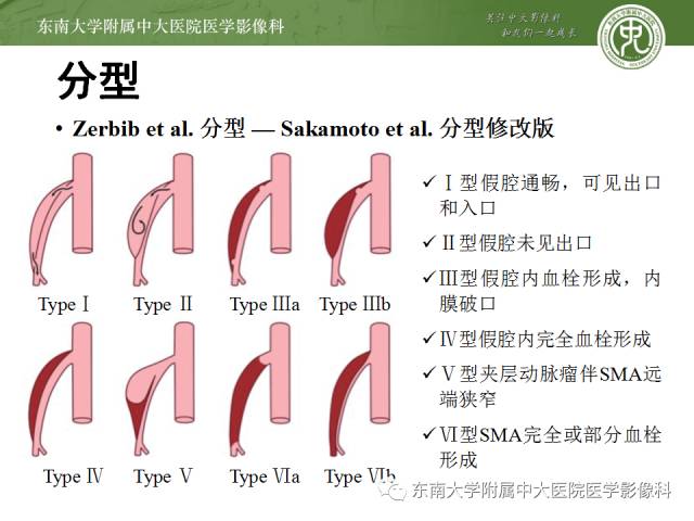 【病例】自发性孤立性肠系膜上动脉夹层1例CT
