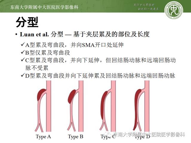 【病例】自发性孤立性肠系膜上动脉夹层1例CT