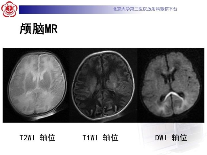【病例】低血糖脑病1例MR影像表现