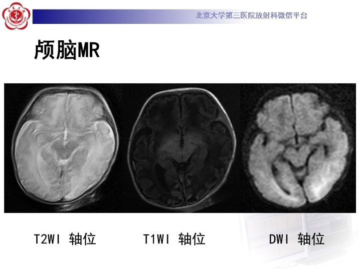【病例】低血糖脑病1例MR影像表现