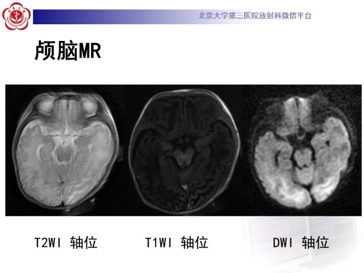 【病例】低血糖脑病1例MR影像表现