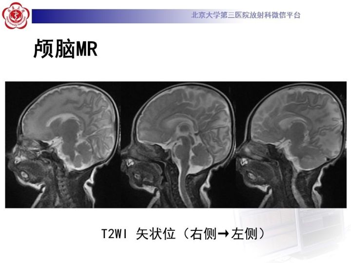 【病例】低血糖脑病1例MR影像表现