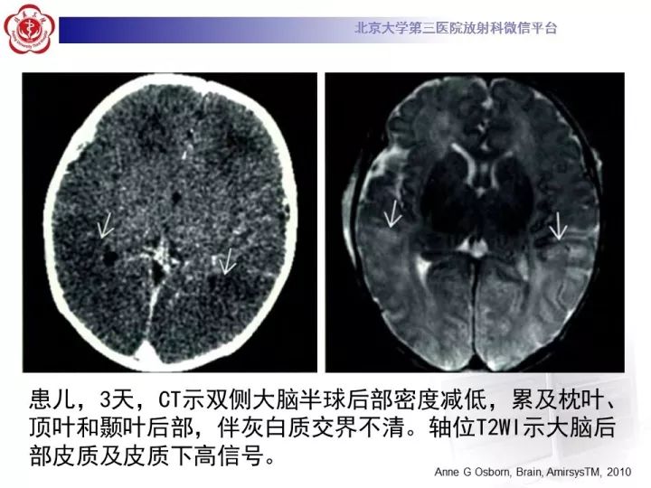 【病例】低血糖脑病1例MR影像表现