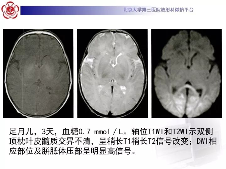 【病例】低血糖脑病1例MR影像表现