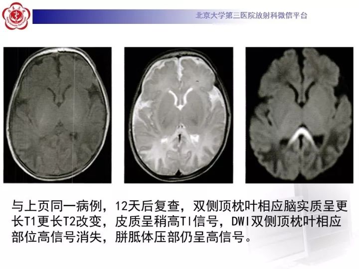【病例】低血糖脑病1例MR影像表现