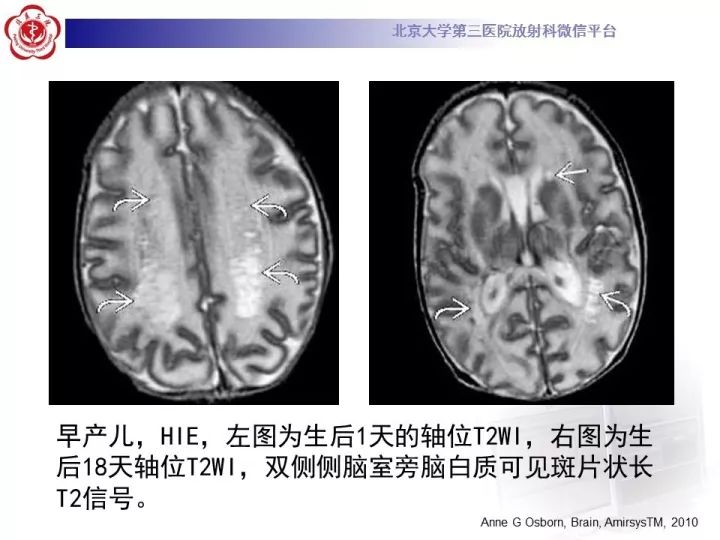 【病例】低血糖脑病1例MR影像表现