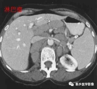 天天诊断“脾大”您想过引起脾大的这21种疾病吗？