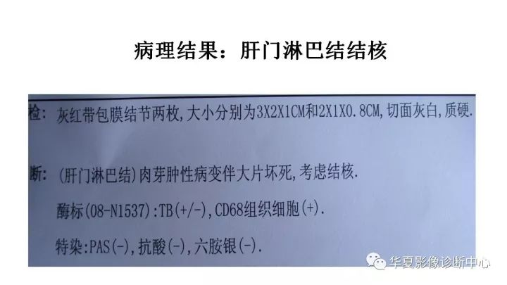 【病例】肝门区淋巴结结核1例CT及MR