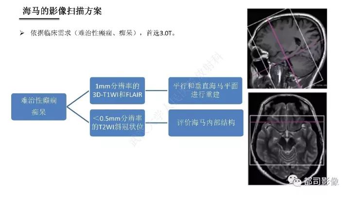 【PPT】海马正常解剖与疾病影像诊断