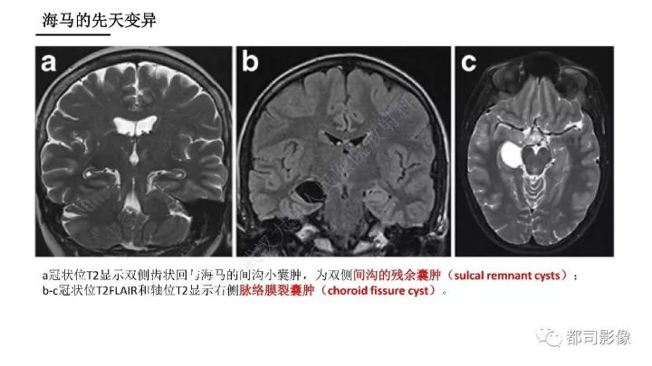 【PPT】海马正常解剖与疾病影像诊断
