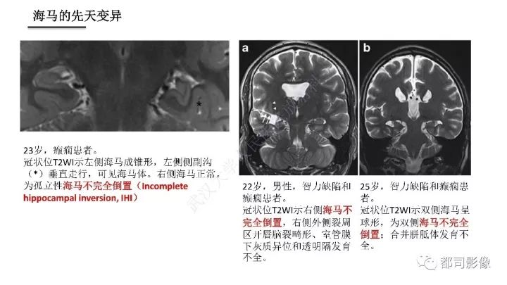 【PPT】海马正常解剖与疾病影像诊断