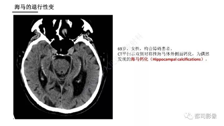 【PPT】海马正常解剖与疾病影像诊断