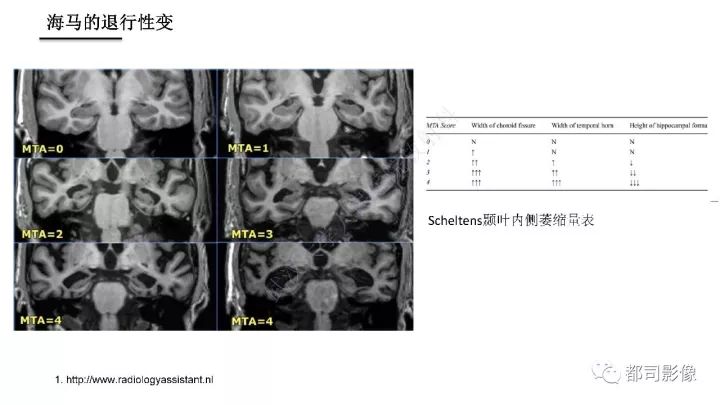 【PPT】海马正常解剖与疾病影像诊断