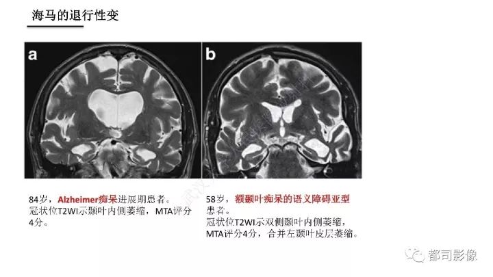 【PPT】海马正常解剖与疾病影像诊断