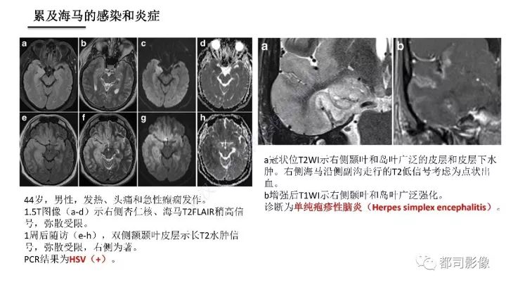 【PPT】海马正常解剖与疾病影像诊断
