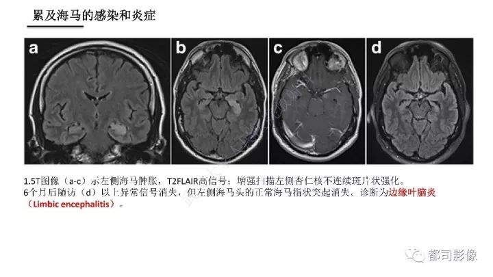 【PPT】海马正常解剖与疾病影像诊断