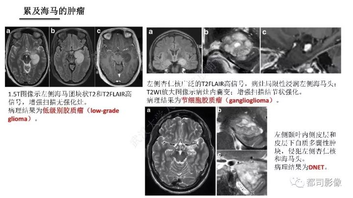 【PPT】海马正常解剖与疾病影像诊断