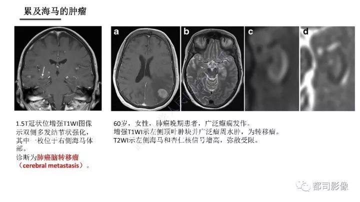 【PPT】海马正常解剖与疾病影像诊断
