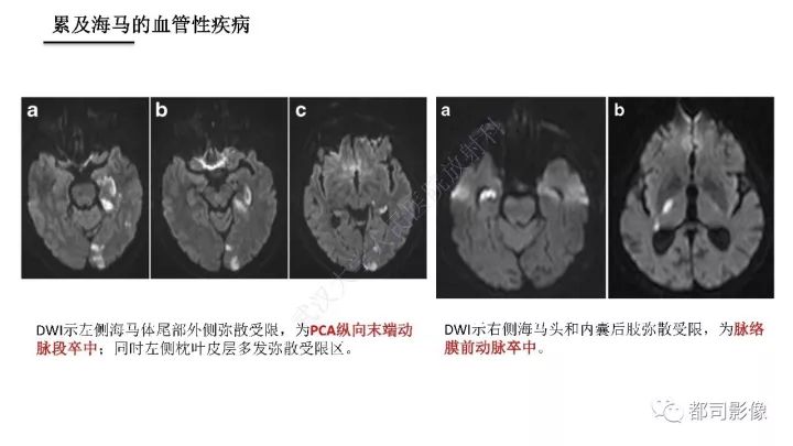 【PPT】海马正常解剖与疾病影像诊断
