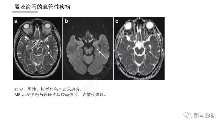 【PPT】海马正常解剖与疾病影像诊断