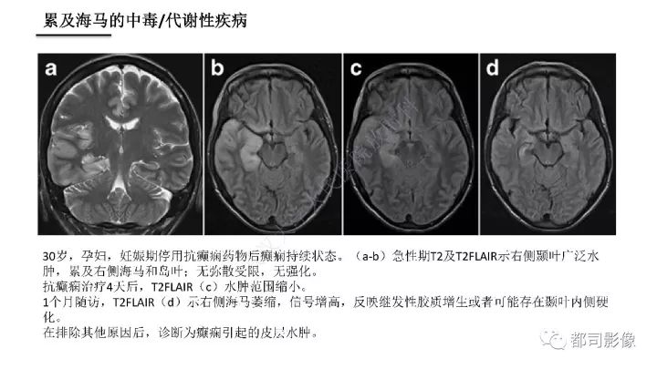 【PPT】海马正常解剖与疾病影像诊断