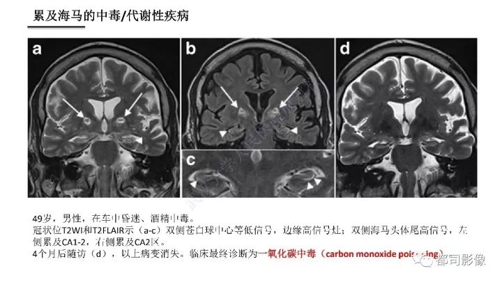 【PPT】海马正常解剖与疾病影像诊断